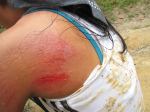 baptized @ Lembah Kiara ! Ouch ! Technical downhill gone absolutely wrong. Injury @ my hips, left knee, and arm. Other pics will not be uploaded. Sorry. LOL !