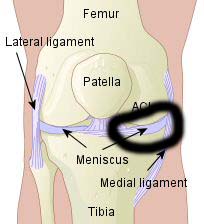 Where the problem lies ; the medial menisci or knee cartilage of the left knee. (This image is of the right knee). 